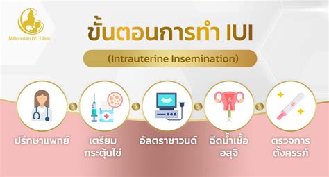 Ilustrácia procesu intrauterinnej inseminácie (IUI)