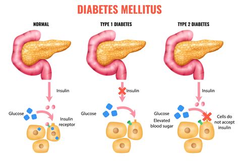 Zjednodušená infografika rozdelenia diabetes mellitus