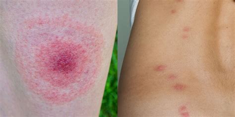 Common insect bites and stings identification