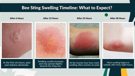 Child's reaction after a sting diagram