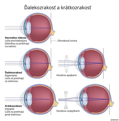 Infografika vysvetľujúca krátkozrakosť a ďalekozrakosť