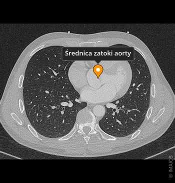 Diagnostické zobrazenie rozšírenej aorty (MRI/CT sken)
