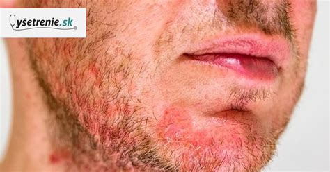 Seboroická dermatitída za uchom