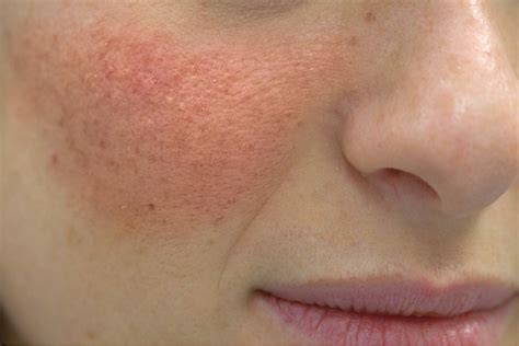 Schéma liečby seboroickej dermatitídy