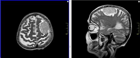 MRI snímka mozgu so zvýraznenými dopamínovými dráhami