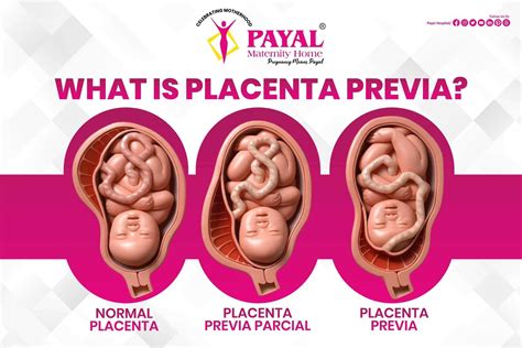 Umiestnenie placenty pri placenta previa
