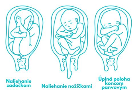 Kritériá pre spontánny pôrod koncom panvovým
