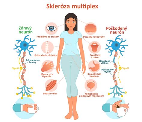 Vplyv sklerózy multiplex na tehotenstvo