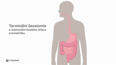 Ileostómia - schéma umiestnenia