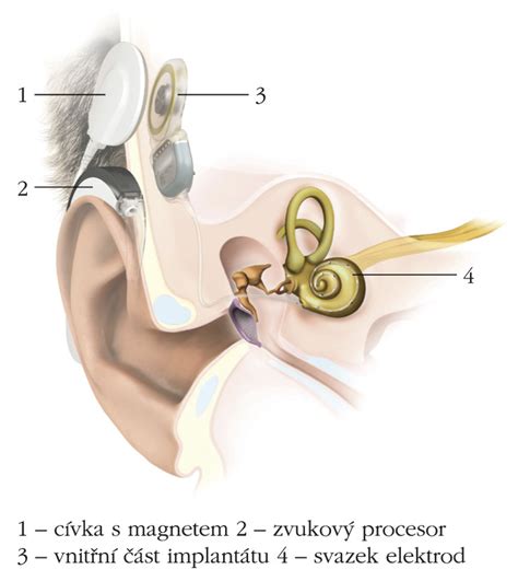 Detailné schéma kochleárneho implantátu