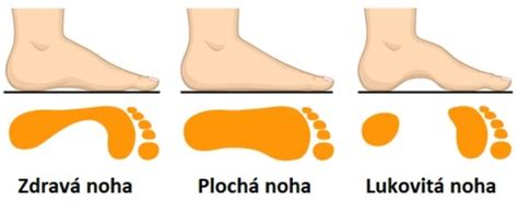 Typy deformít nôh (plocha noha, vbočené päty)