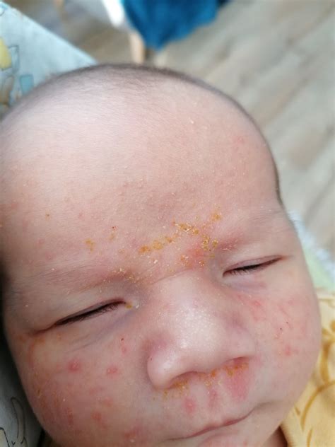 novorodenec s vyrážkami na tvári
