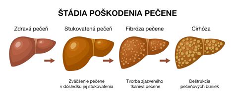 Schematické zobrazenie deformácie kĺbov pri W-sedu