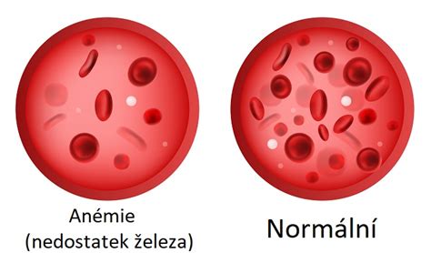 Schéma vývoja anémie z nedostatku železa