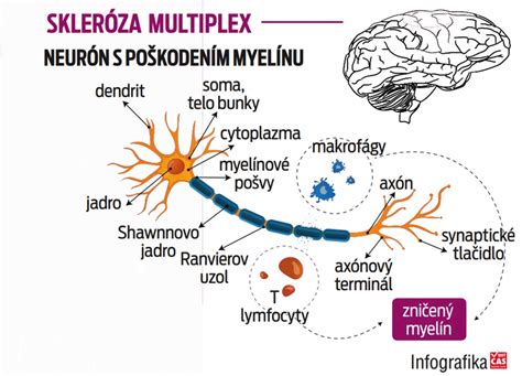 Infografika - skleróza multiplex a tehotenstvo