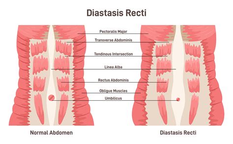 Comparison of baby's belly with and without diastasis engagement