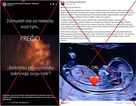 Prenatálny ultrazvuk - meranie šije