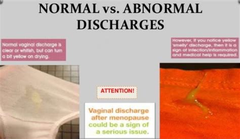 Comparison of Normal vs. Abnormal Vaginal Discharge