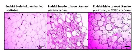 Schéma pôsobenia ultrazvukových vĺn na tukové tkanivo vs. tkanivo plodu