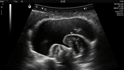 Zobrazenie šijového prejasnenia (NT) na ultrazvuku