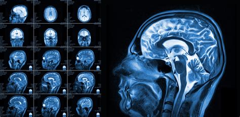 Schéma porovnania RTG, USG a MRI kĺbu