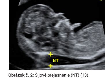 Ultrazvukové zobrazenie nosovej kostičky (NB)