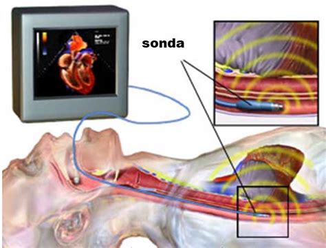 Echokardiografia srdca