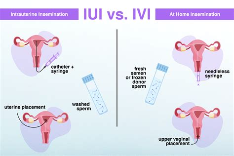 Diagram IUI postupu