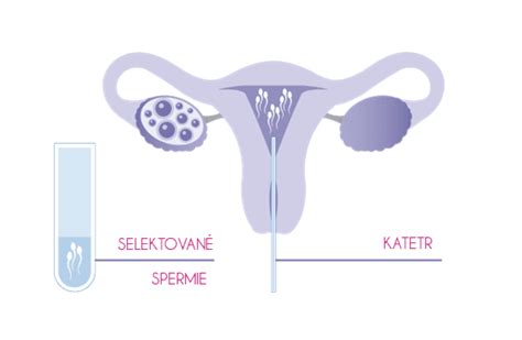 Schéma metódy IUI (Intrauterinná inseminácia)