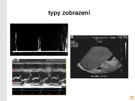 Zobrazenie tehotenského ultrazvuku