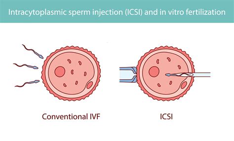 Porovnanie metód IVF a ICSI