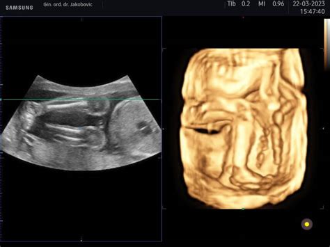 Mapa gynekologických ambulancií ponúkajúcich 3D/4D ultrazvuk