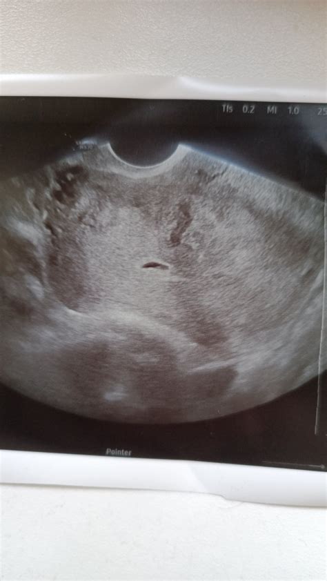 Zobrazenie embryotransferu