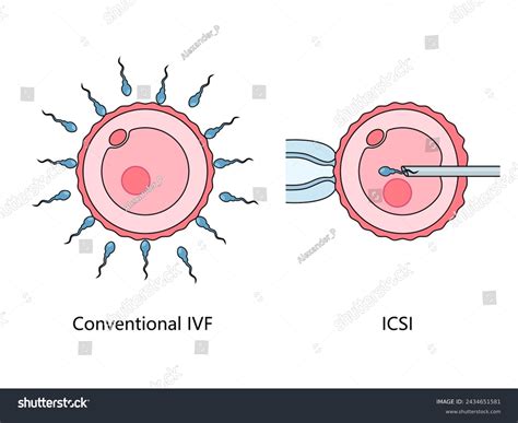 Detailné kroky IVF procedúry