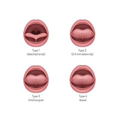 Diagram prirasteného jazyka (ankyloglossia)