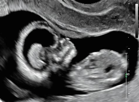 fetus reacting to music ultrasound