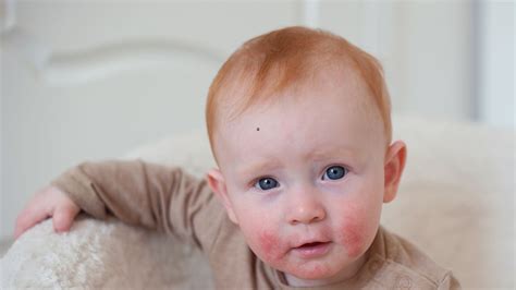 Dieťa s atopickým ekzémom na tvári