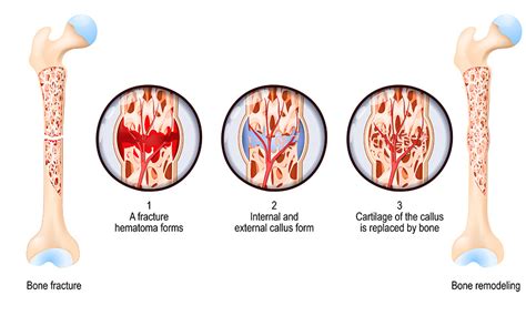Child vs. adult bone healing illustration