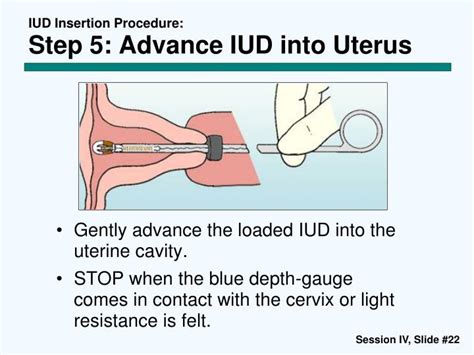 IUD insertion procedure diagram