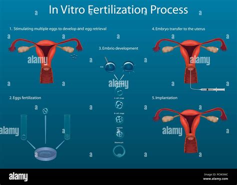 Schéma procesu IVF (In Vitro Fertilization)