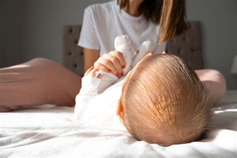 Mliečna chrasta na hlave bábätka