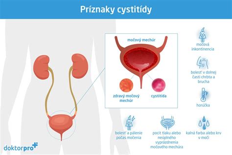 Bežné príznaky zápalu močových ciest