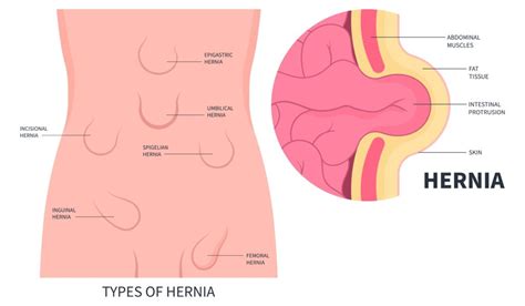 Pupočná hernia u dojčaťa