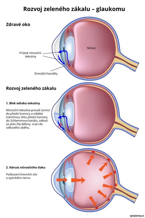 Zelený zákal a poškodený zrakový nerv