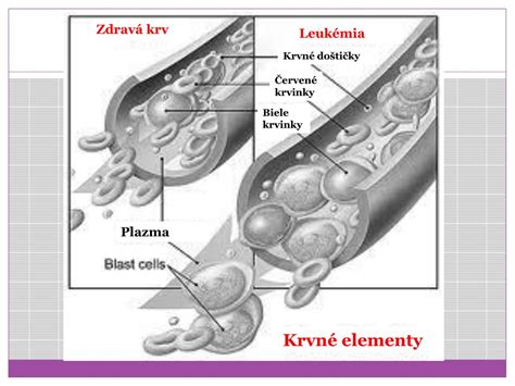 schéma rozkladu červených krviniek a vzniku bilirubínu u novorodenca