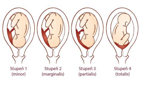 symbolické znázornenie maternice s placentou praevia