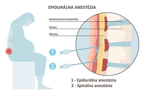 Schéma podania epidurálnej analgézie