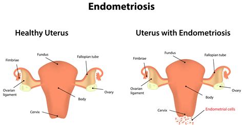Schéma normálneho a zhrubnutého endometria