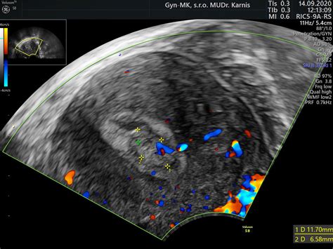 Endometriálny polyp