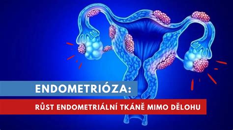 Adenomyóza a endometrióza